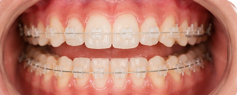 Clear ceramic brackets on the upper and lower arch