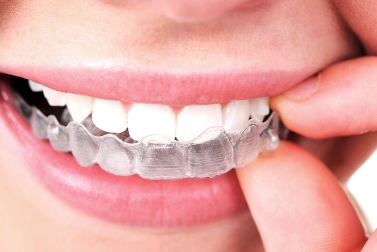 Close-up of a patient placing a clear Invisalign aligner tray