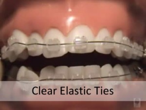 clear elastic ties