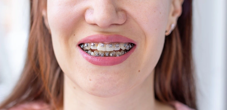 Close-up of a smile with traditional metal braces on the upper and lower teeth